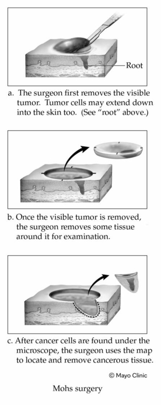 Mohs surgery illustration Mohs surgery illustration