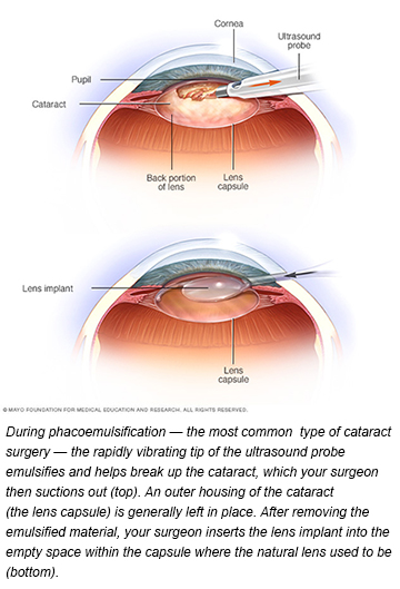 mayo clinic on laser one touch