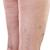 Varicose Veins_small