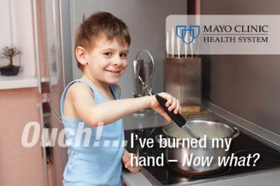 Ouch! I've burned my hand on a hot pan — now what?