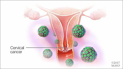 Cervical Cancer