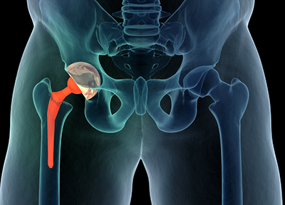 Hip Replacement - Hip - Surgery - What We Treat 
