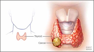 a-medical-illustration-of-thyroid-cancer