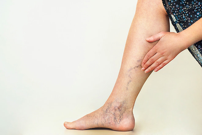 Spider veins - Mayo Clinic