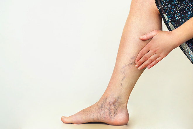 Woman touching varicose veins on leg