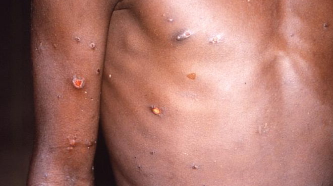 7 Things To Know About Monkeypox