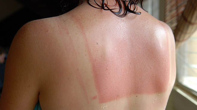 Frugal Sunburn Treatments to Soothe and Relieve the pain