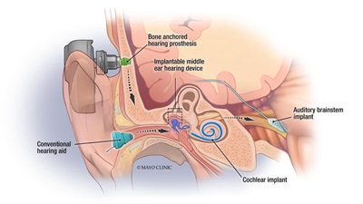 Hearing devices illustration