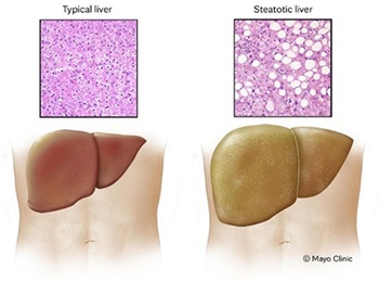 Illustration of typical liver and steatotic liver