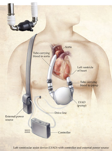 lvad graphic