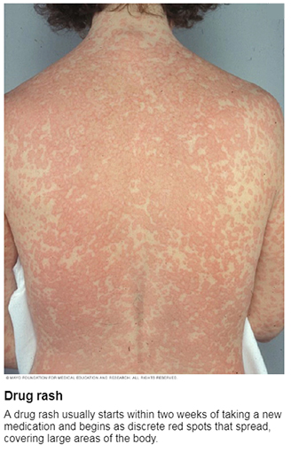 clindamycin skin rash