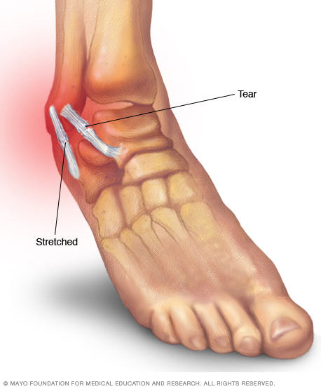 pulled muscle in sole of foot