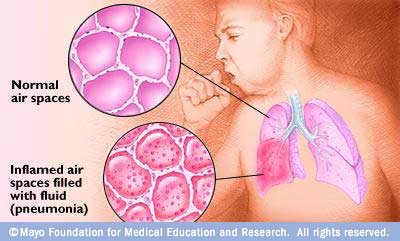 Pneumonia