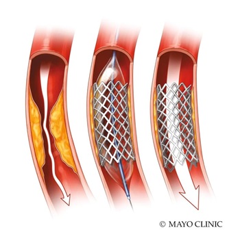 Illustration of Balloon and Stenting