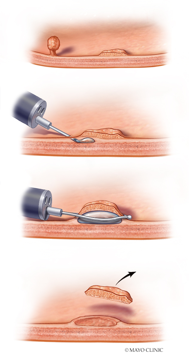 Digestive Tests/procedures, La Crosse - Mayo Clinic Health System