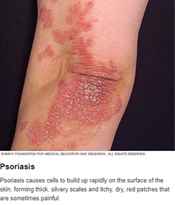 Psoriasis