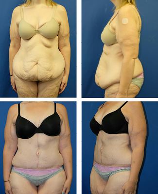 The Abdominal Panniculectomy vs Tummy Tuck in the Extreme Weight Loss  Patient - Explore Plastic Surgery