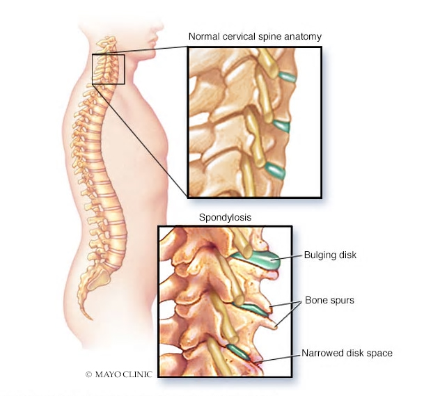 Heel spur symptoms mayo on sale clinic